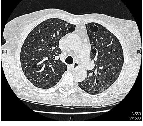 the villages lung ct scan|HRCT (High.